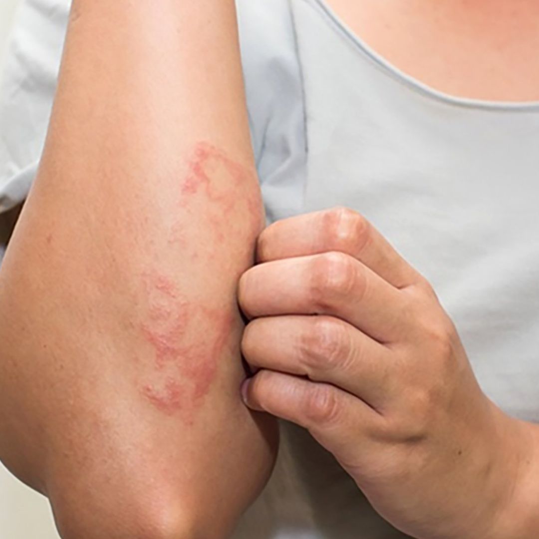 Severe Allergic Reaction